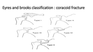 Eyres and brooks classification : coracoid fracture
 