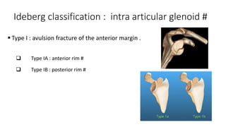 Ideberg classification : intra articular glenoid #
 Type I : avulsion fracture of the anterior margin .
 Type IA : anterior rim #
 Type IB : posterior rim #
 