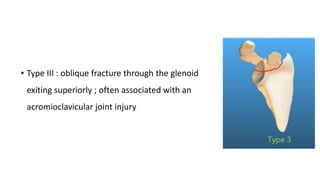 • Type III : oblique fracture through the glenoid
exiting superiorly ; often associated with an
acromioclavicular joint injury
 