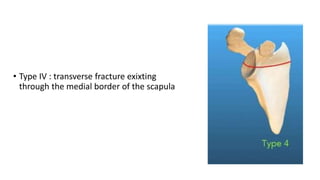 • Type IV : transverse fracture exixting
through the medial border of the scapula
 