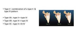 • Type V : combination of a type II &
type IV pattern
• Type VA : type II + type IV
• Type VB : type III + type IV
• Type VC : type II+ III+IV
 