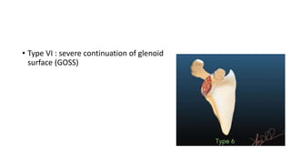 • Type VI : severe continuation of glenoid
surface (GOSS)
 