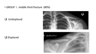 • GROUP I . middle third fracture (80%)
 Undisplaced
 Displaced
 