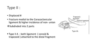 Type II :
• Displaced #
• Fracture medial to the Coracoclavicular
ligament & higher incidence of non- union
Subdivded into 2 parts
 Type II A : both ligament ( conoid &
trapezoid ) attached to the distal fragment
 