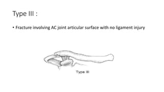 Type III :
• Fracture involving AC joint articular surface with no ligament injury
 