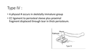 Type IV :
• A physeal # occurs in skeletally immature group
• CC ligament to periosteal sleeve plus proximal
fragment displaced through tear in thick periosteum.
 