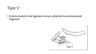 Type V :
• Commuinuted # and ligament remain attached to commuinuted
fragment
 