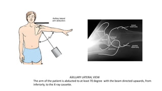 AXILLARY LATERAL VIEW
The arm of the patient is abducted to at least 70 degree with the beam directed upwards, from
inferiorly, to the X-ray cassette.
 