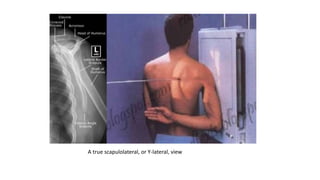 A true scapulolateral, or Y-lateral, view
 