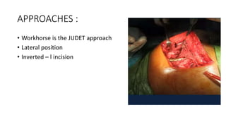 APPROACHES :
• Workhorse is the JUDET approach
• Lateral position
• Inverted – l incision
 
