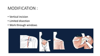 MODIFICATION :
• Vertical incision
• Limited disection
• Work through windows
 