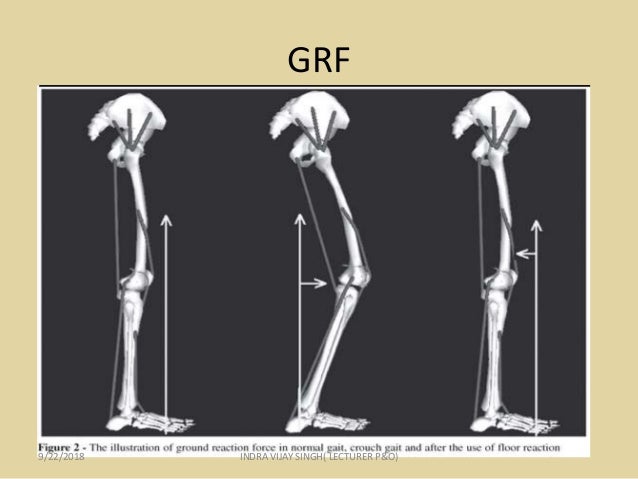 Floor Reaction Orthosis