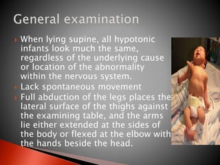  When lying supine, all hypotonic
infants look much the same,
regardless of the underlying cause
or location of the abnormality
within the nervous system.
 Lack spontaneous movement
 Full abduction of the legs places the
lateral surface of the thighs against
the examining table, and the arms
lie either extended at the sides of
the body or flexed at the elbow with
the hands beside the head.
 