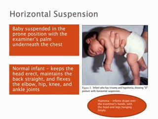 Normal infant - keeps the
head erect, maintains the
back straight, and flexes
the elbow, hip, knee, and
ankle joints
Baby suspended in the
prone position with the
examiner’s palm
underneath the chest
Hyptonia - infants drape over
the examiner's hands, with
the head and legs hanging
limply
 