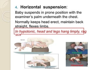 4. Horizontal suspension:
Baby suspends in prone position with the
examiner’s palm underneath the chest.
Normally keeps head erect, maintain back
straight, flexes limbs.
In hypotonic, head and legs hang limply, rag
doll.
 