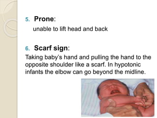 5. Prone:
unable to lift head and back
6. Scarf sign:
Taking baby’s hand and pulling the hand to the
opposite shoulder like a scarf. In hypotonic
infants the elbow can go beyond the midline.
 