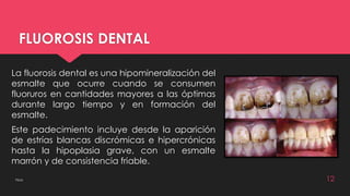 FLUOROSIS DENTAL 
La fluorosis dental es una hipomineralización del 
esmalte que ocurre cuando se consumen 
fluoruros en cantidades mayores a las óptimas 
durante largo tiempo y en formación del 
esmalte. 
Este padecimiento incluye desde la aparición 
de estrías blancas discrómicas e hipercrónicas 
hasta la hipoplasia grave, con un esmalte 
marrón y de consistencia friable. 
Flúor 12 
 