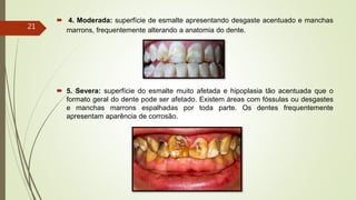  4. Moderada: superfície de esmalte apresentando desgaste acentuado e manchas
marrons, frequentemente alterando a anatomia do dente.
 5. Severa: superfície do esmalte muito afetada e hipoplasia tão acentuada que o
formato geral do dente pode ser afetado. Existem áreas com fóssulas ou desgastes
e manchas marrons espalhadas por toda parte. Os dentes frequentemente
apresentam aparência de corrosão.
21
 