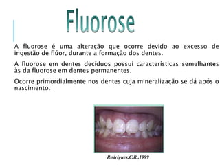 A fluorose é uma alteração que ocorre devido ao excesso de
ingestão de flúor, durante a formação dos dentes.
A fluorose em dentes decíduos possui características semelhantes
às da fluorose em dentes permanentes.
Ocorre primordialmente nos dentes cuja mineralização se dá após o
nascimento.
Rodrigues,C.R.,1999
 