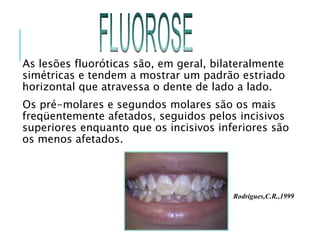 As lesões fluoróticas são, em geral, bilateralmente
simétricas e tendem a mostrar um padrão estriado
horizontal que atravessa o dente de lado a lado.
Os pré-molares e segundos molares são os mais
freqüentemente afetados, seguidos pelos incisivos
superiores enquanto que os incisivos inferiores são
os menos afetados.
Rodrigues,C.R.,1999
 