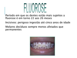 Período em que os dentes estão mais sujeitos a
fluorose é em torno 22 aos 26 meses
Incisivos: perigoso ingestão até cinco anos de idade
Molares decíduos sempre menos afetados que
permanentes
 