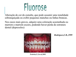 Alteração de cor do esmalte, que pode assumir uma tonalidade
esbranquiçada ou exibir pequenas manchas ou linhas brancas.
Nos casos mais graves, adquire uma coloração acastanhada ou
marrom e marrom escuro, podendo haver perda de estrutura
dental (depressões)
Tredwin,C.J.et al,2005.
Rodrigues,C.R.,1999
 