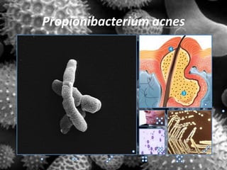 Propionibacterium acnes
 