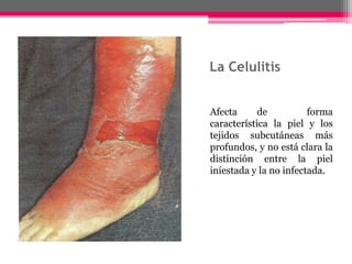 La Celulitis


Afecta      de          forma
característica la piel y los
tejidos subcutáneas más
profundos, y no está clara la
distinción entre la piel
iníestada y la no infectada.
 