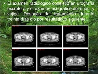 • El examen radiológico consistió en urografía
excretora y el examen ecográfico del riñón y
vejiga. Después del tratamiento durante
treinta días dio por resultado lo siguiente:
 
