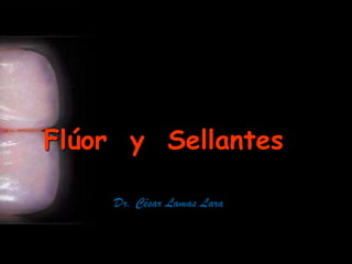 Flúor  y  Sellantes Dr. César Lamas Lara 