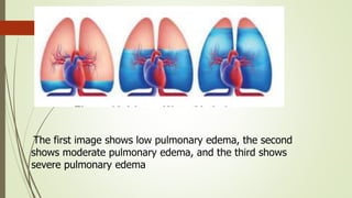 The first image shows low pulmonary edema, the second
shows moderate pulmonary edema, and the third shows
severe pulmonary edema
 
