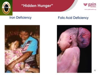 11
“Hidden Hunger”
Iron Deficiency Folic Acid Deficiency
 