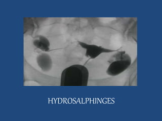 HYDROSALPHINGES 
 
