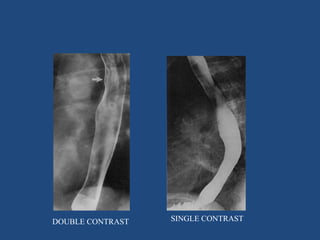 DOUBLE CONTRAST SINGLE CONTRAST 
 