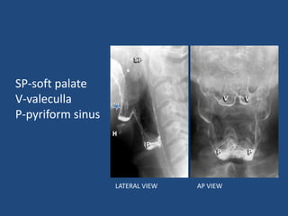 SP-soft palate 
V-valeculla 
P-pyriform sinus 
LATERAL VIEW AP VIEW 
 