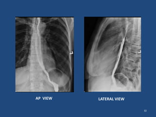 32 
AP VIEW LATERAL VIEW 
 