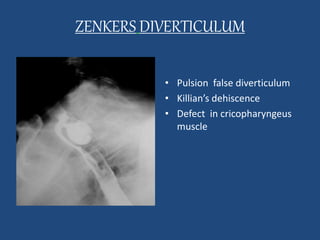 ZENKERS DIVERTICULUM 
• ZENKER’S 
DIVERTICULUM • Pulsion false diverticulum 
• Killian’s dehiscence 
• Defect in cricopharyngeus 
muscle 
 