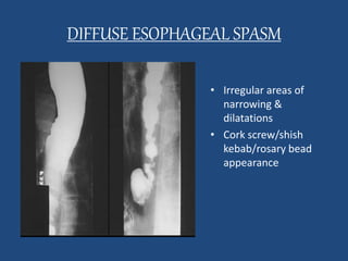 DIFFUSE ESOPHAGEAL SPASM 
• Irregular areas of 
narrowing & 
dilatations 
• Cork screw/shish 
kebab/rosary bead 
appearance 
 