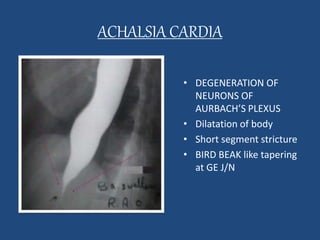ACHALSIA CARDIA 
*With short segment 
stricture. 
* A “bird-peak " like 
tapering of the 
esophagus at the GE 
junction. OR 
• DEGENERATION OF 
NEURONS OF 
AURBACH’S PLEXUS 
• Dilatation of body 
• Short segment stricture 
• BIRD BEAK like tapering 
at GE J/N 
 