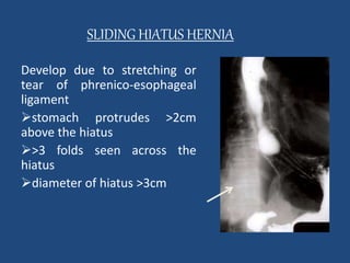 SLIDING HIATUS HERNIA 
Develop due to stretching or 
tear of phrenico-esophageal 
ligament 
stomach protrudes >2cm 
above the hiatus 
>3 folds seen across the 
hiatus 
diameter of hiatus >3cm 
 