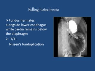Rolling hiatus hernia 
Fundus herniates 
alongside lower esophagus 
while cardia remains below 
the diaphragm 
 T/T– 
Nissen’s fundoplication 
 