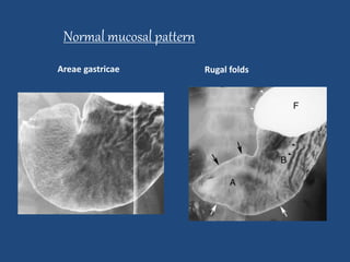 Normal mucosal pattern 
Areae gastricae Rugal folds 
 