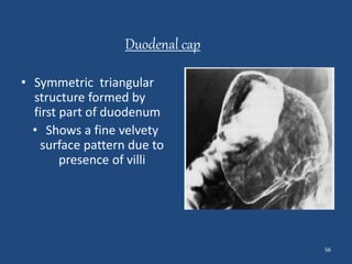 56 
Duodenal cap 
• Symmetric triangular 
structure formed by 
first part of duodenum 
• Shows a fine velvety 
surface pattern due to 
presence of villi 
 