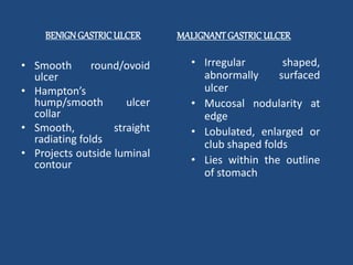 BENIGN GASTRIC ULCER MALIGNANT GASTRIC ULCER 
• Smooth round/ovoid 
ulcer 
• Hampton’s 
hump/smooth ulcer 
collar 
• Smooth, straight 
radiating folds 
• Projects outside luminal 
contour 
• Irregular shaped, 
abnormally surfaced 
ulcer 
• Mucosal nodularity at 
edge 
• Lobulated, enlarged or 
club shaped folds 
• Lies within the outline 
of stomach 
 