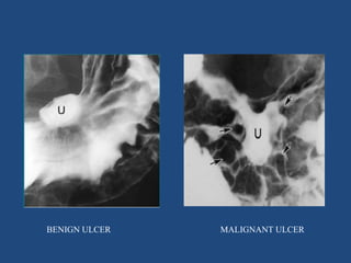 BENIGN ULCER MALIGNANT ULCER 
 