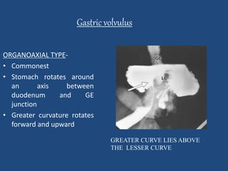 Gastric volvulus 
ORGANOAXIAL TYPE- 
• Commonest 
• Stomach rotates around 
an axis between 
duodenum and GE 
junction 
• Greater curvature rotates 
forward and upward 
GREATER CURVE LIES ABOVE 
THE LESSER CURVE 
 