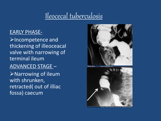 Ileocecal tuberculosis 
EARLY PHASE- 
Incompetence and 
thickening of illeoceacal 
valve with narrowing of 
terminal ileum 
ADVANCED STAGE – 
Narrowing of ileum 
with shrunken, 
retracted( out of illiac 
fossa) caecum 
 
