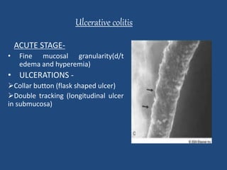 Ulcerative colitis 
ACUTE STAGE- 
• Fine mucosal granularity(d/t 
edema and hyperemia) 
• ULCERATIONS - 
Collar button (flask shaped ulcer) 
Double tracking (longitudinal ulcer 
in submucosa) 
 