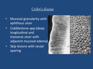 Crohn’s disease 
• Mucosal granularity with 
aphthous ulcer 
• Cobblestone app.(deep 
longitudinal and 
trasverse ulcer with 
adjacent mucosal edema) 
• Skip lesions with rectal 
sparing 
 