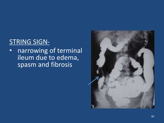 84 
STRING SIGN- 
• narrowing of terminal 
ileum due to edema, 
spasm and fibrosis 
 